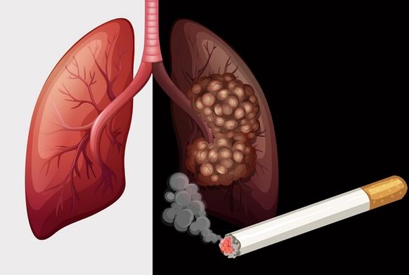 Polmoni del fumatore e polmoni sani