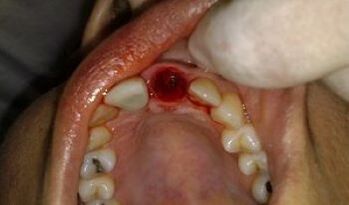 la posizione del dente estratto